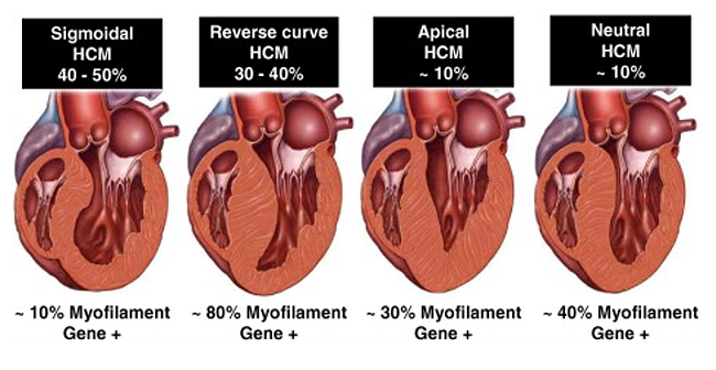 Diagnosis And Management Of Hypertrophic Cardiomyopathy - American ...